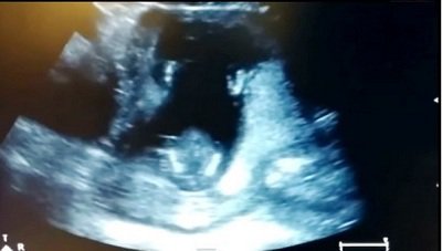 видеосюжет, в котором видно, как во время ультразвукового исследования 14-недельный нерождённый ребенок в животе матери хлопает в ладоши под ее пение. видеосюжет, в котором видно, как во время ультразвукового исследования 14-недельный нерождённый ребенок в животе матери хлопает в ладоши под ее пение.